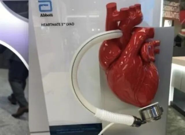 雅培的植入式人工心脏Heartmate。